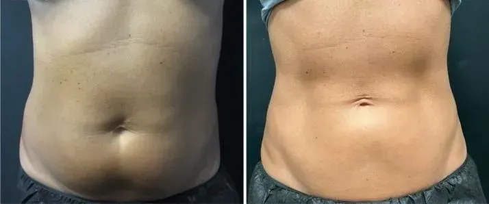 Före och efter Insculpt: magen framifrån, jämnare kontur och mindre buk